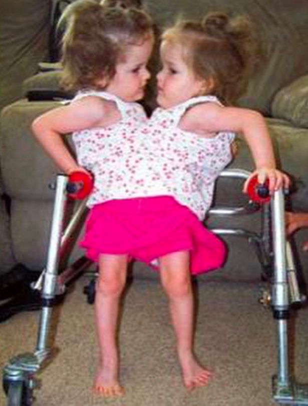 The twins using a walking aid as children