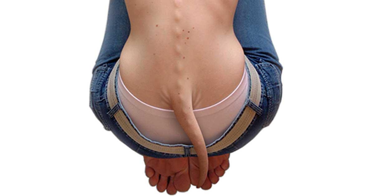 An archive image showing a tail-like structure near a lower back; no diagnosis or identity verified.