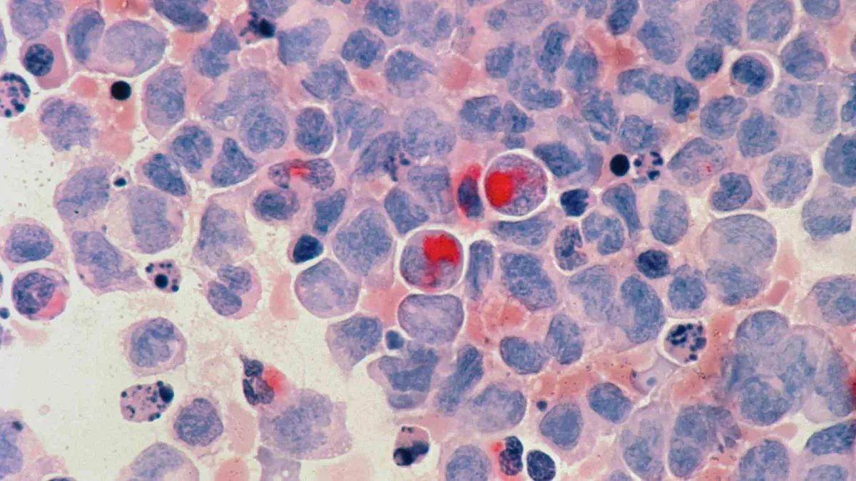 Cells from Acute myelocytic leukaemia.