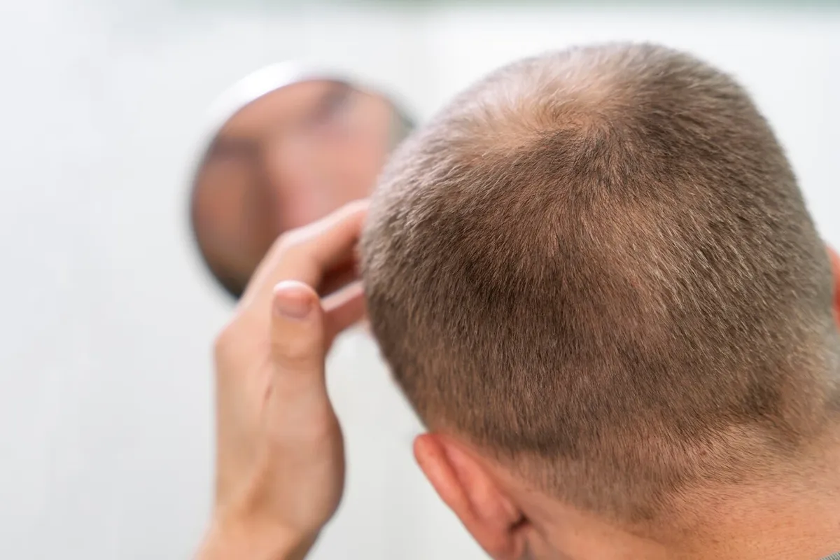adult male with balding problem looking into the mirror