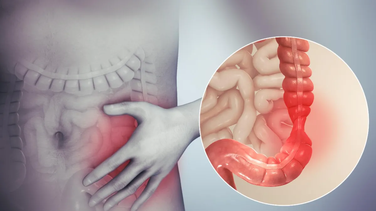 An illustration of a body with inflammatory bowel disease