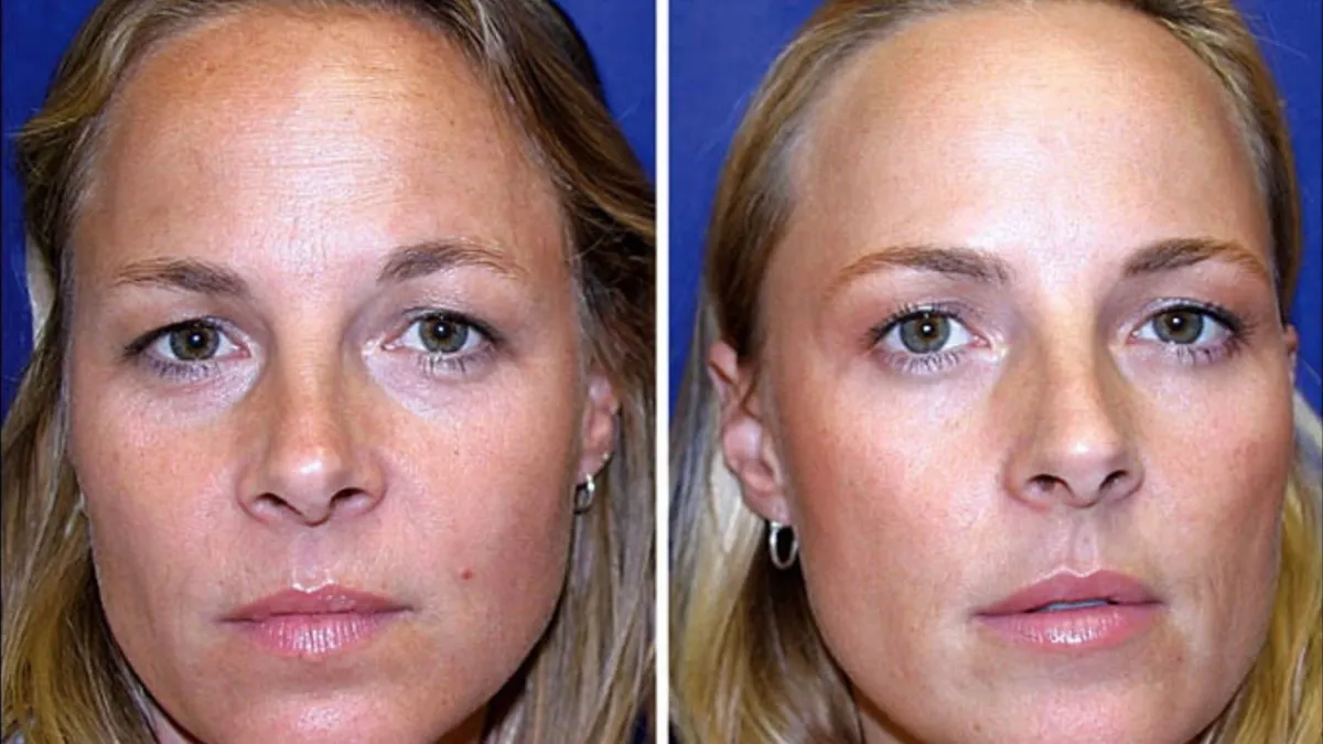 Side-by-side images of two identical female twins' faces against a blue background. The twin on the left shows visible signs of aging, such as fine lines around the eyes and mouth, while the twin on the right has a smoother complexion with fewer wrinkles, suggesting the effects of Botox treatments