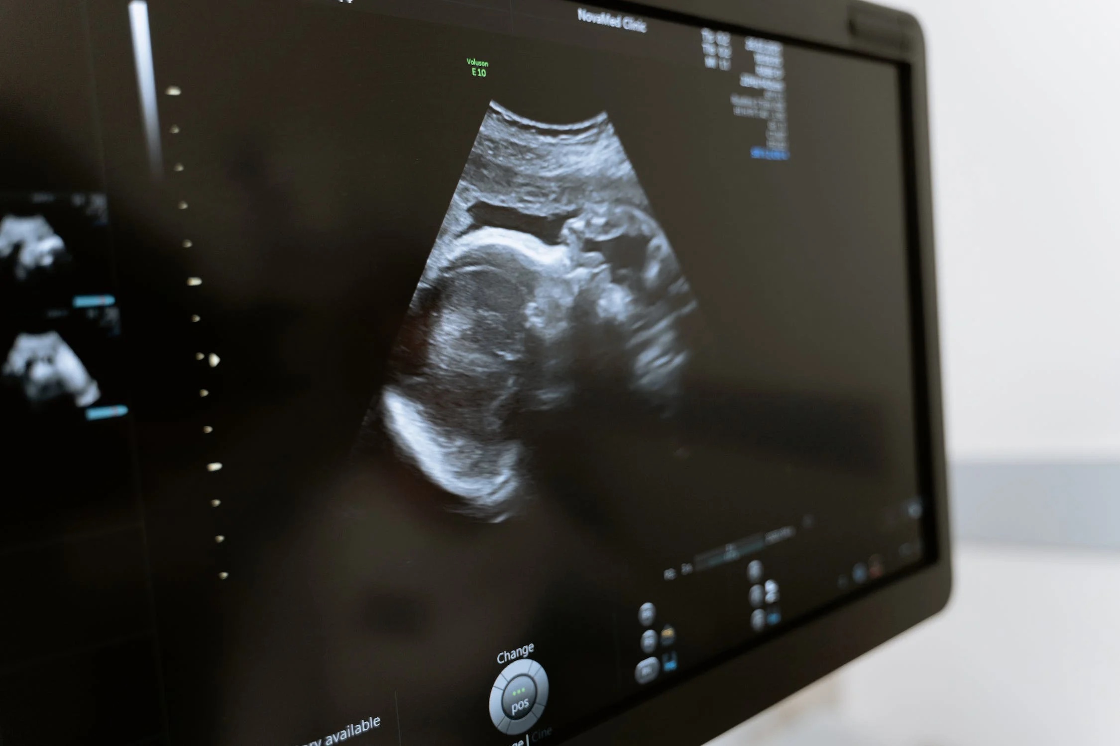 An ultrasound image displayed on a screen