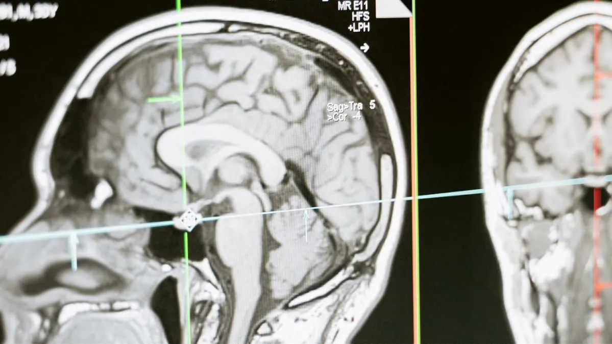 An MRI scan displaying cross-sectional images of a human brain