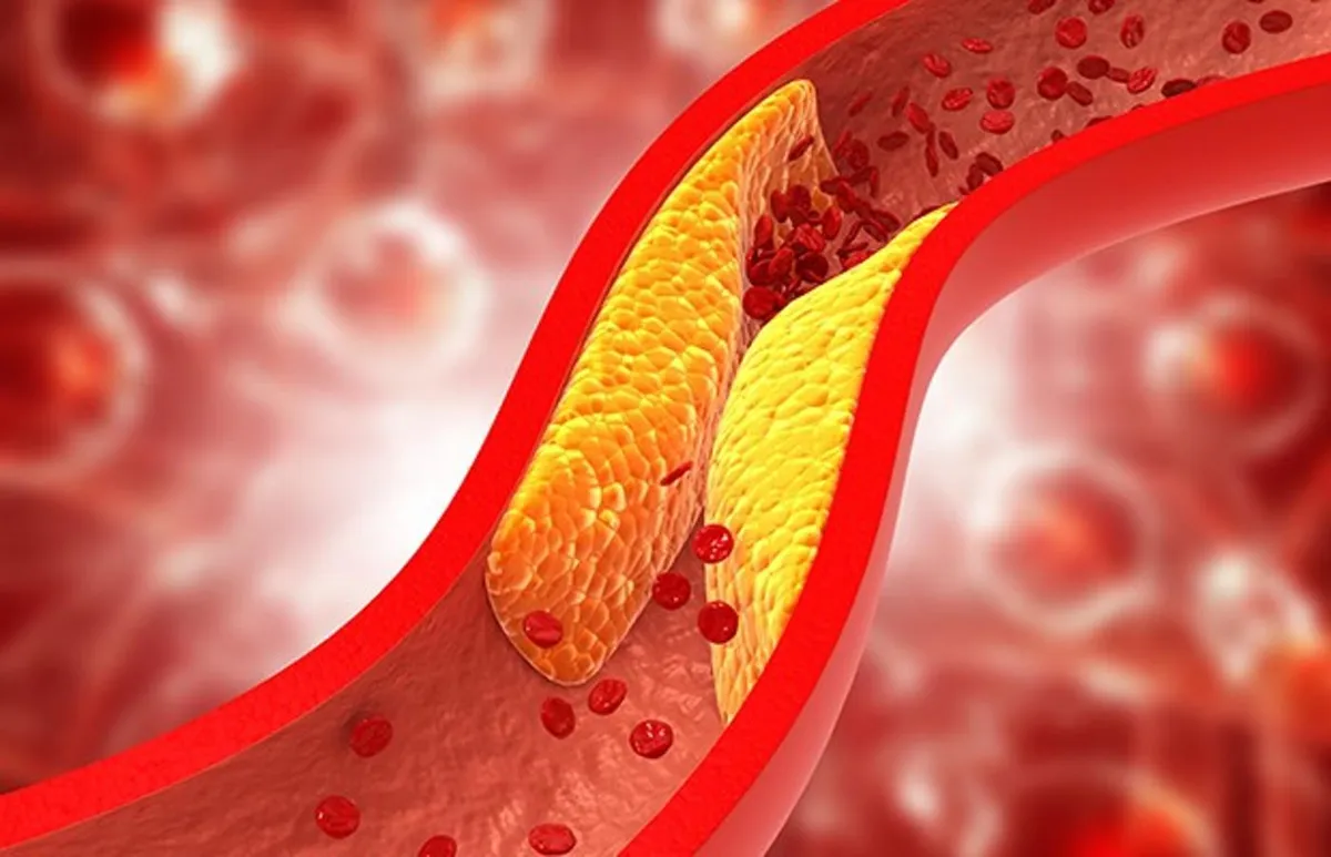 A digital illustration of bad cholesterol building up and clogging the arteries