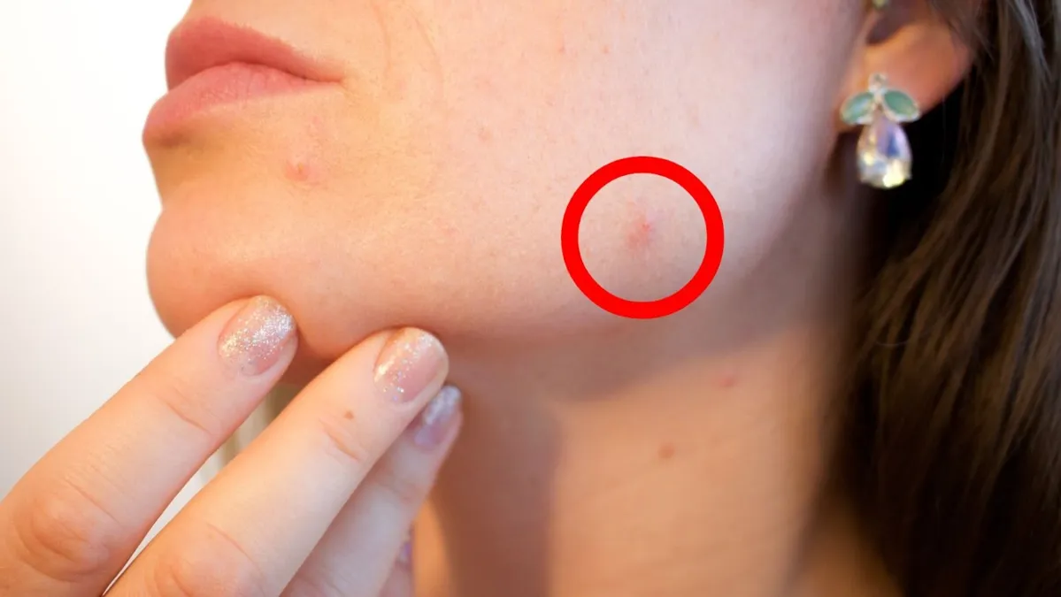 A close-up of a woman with red acne on her face, one pimple is circled in red.