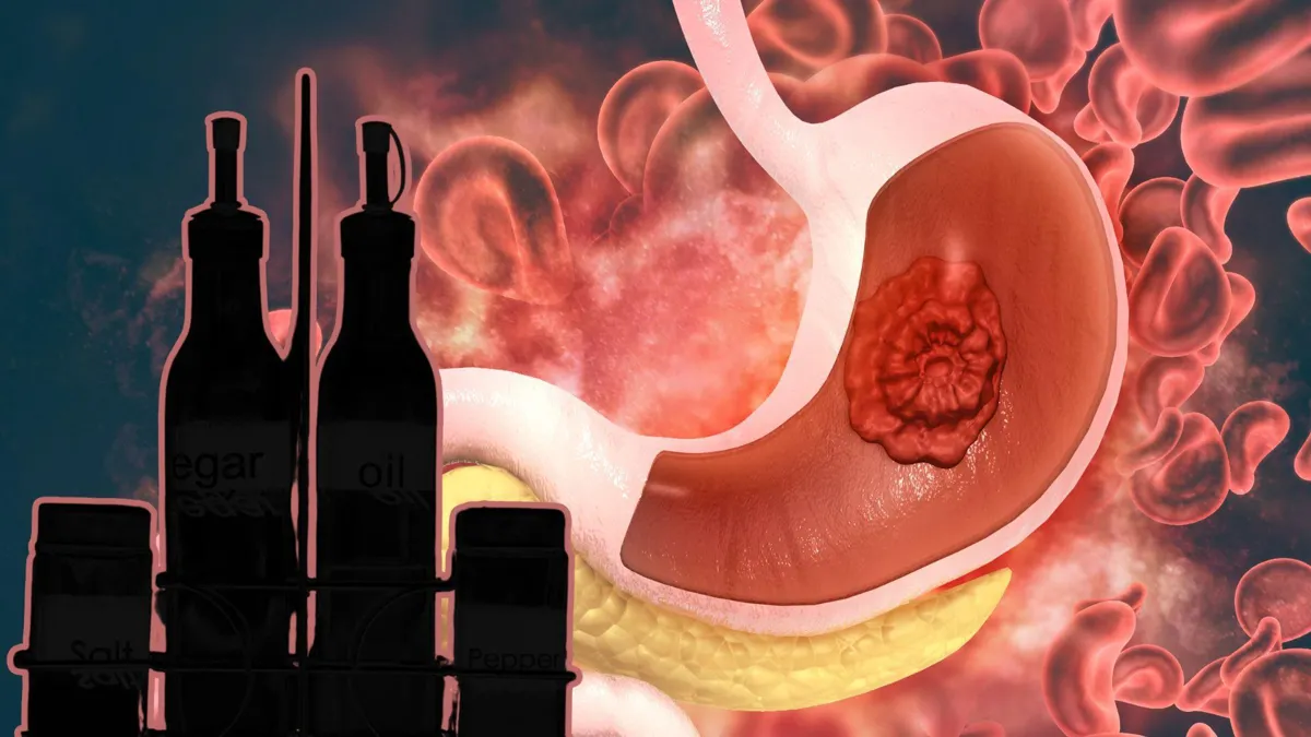 A digital illustration of a human stomach with cancer/A silhouette of condiments found on a table