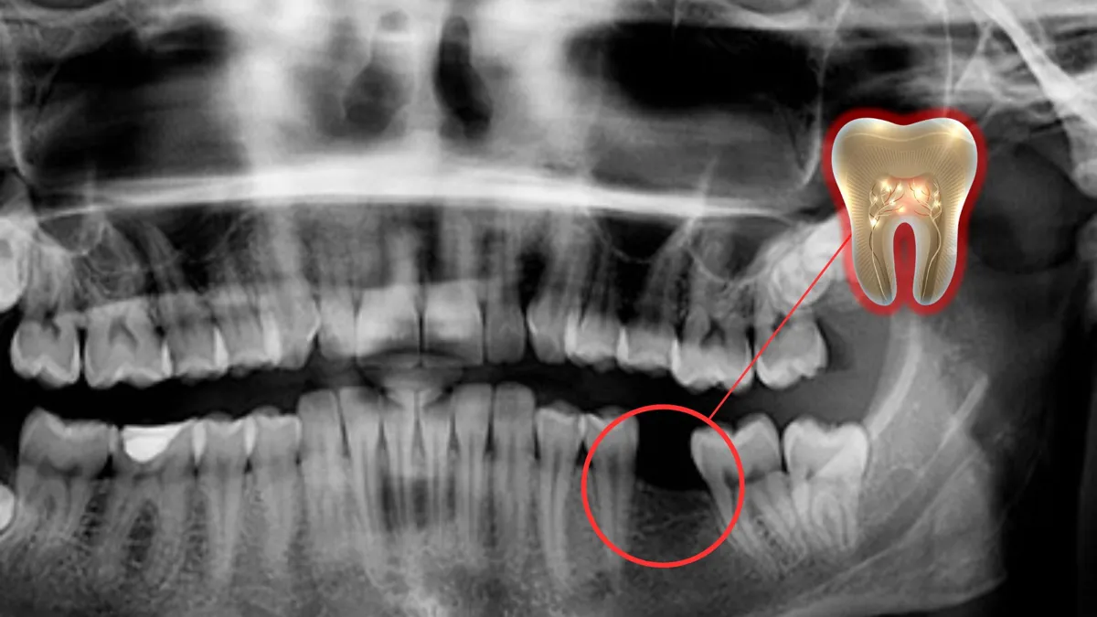 Professor Discovered Drug That Fixes Cavities and Regrows Teeth