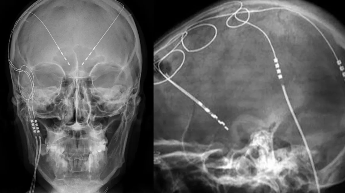 Two side-by-side X-ray images of a human skull. The left image is a frontal view, showing the visible dbs devices implanted in the skull. The right image is a lateral view, highlighting the side profile of the skull with a clear view of the intracranial devices, which include wire leads and electrodes