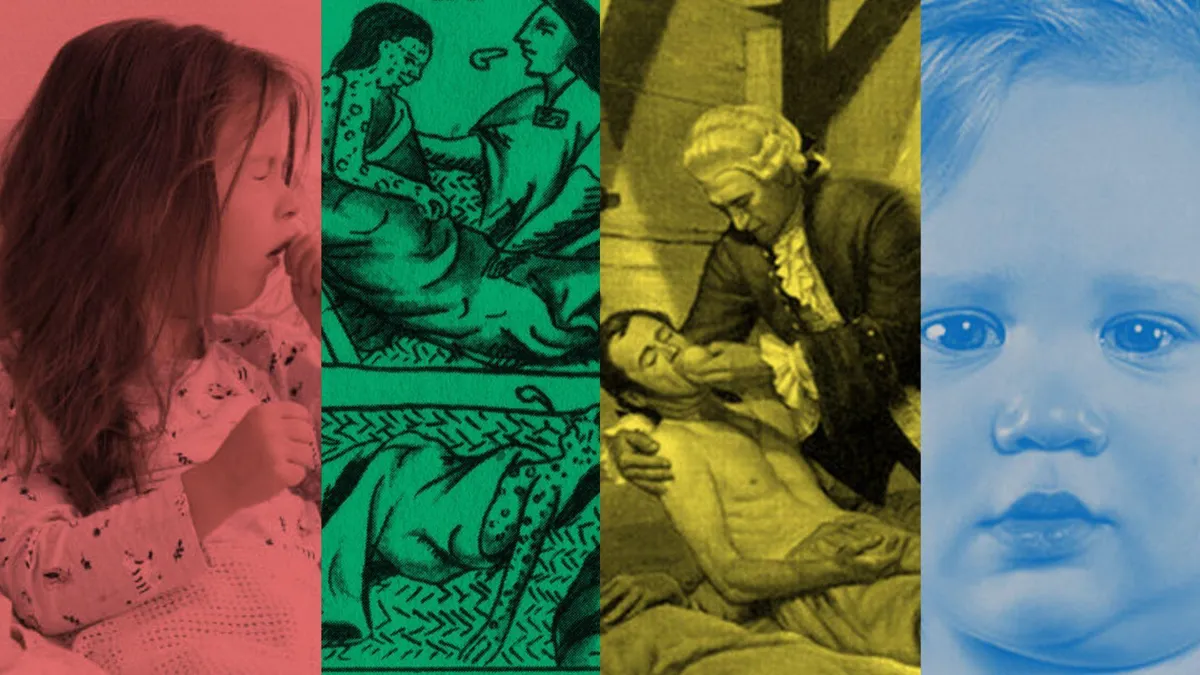 A young child coughing/A drawing of smallpox from the 16th century/A painting of a sailor with scurvy/A young child with mumps