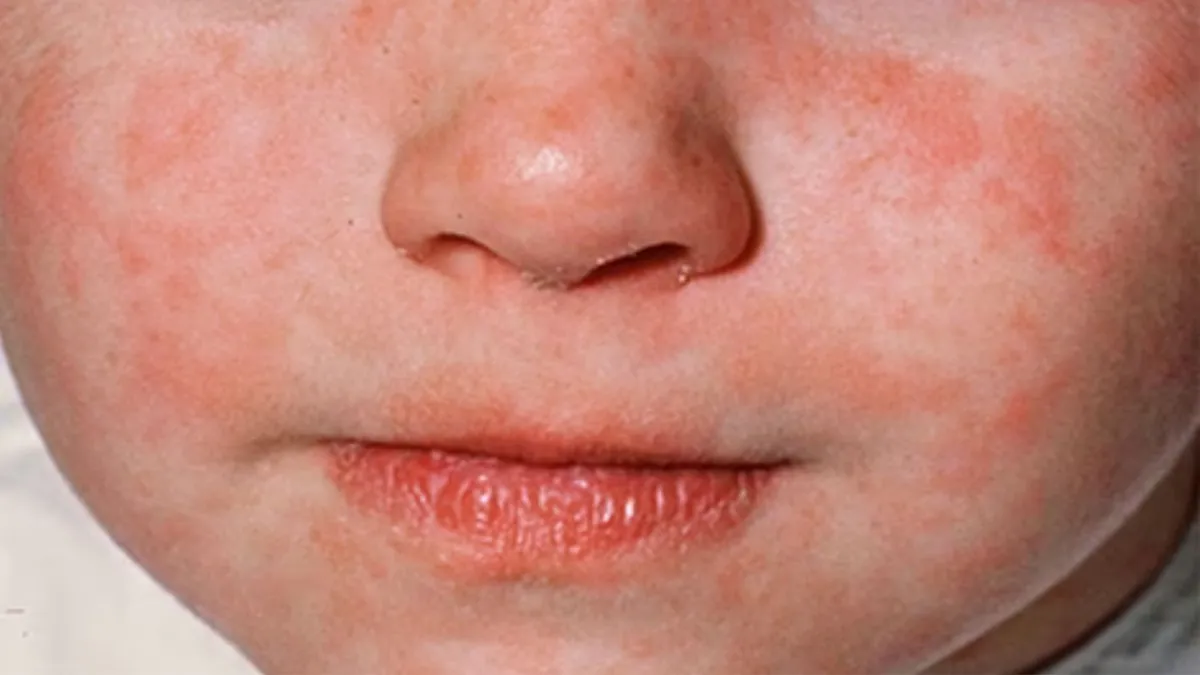 Close-up of a child’s face who has been infected with measles