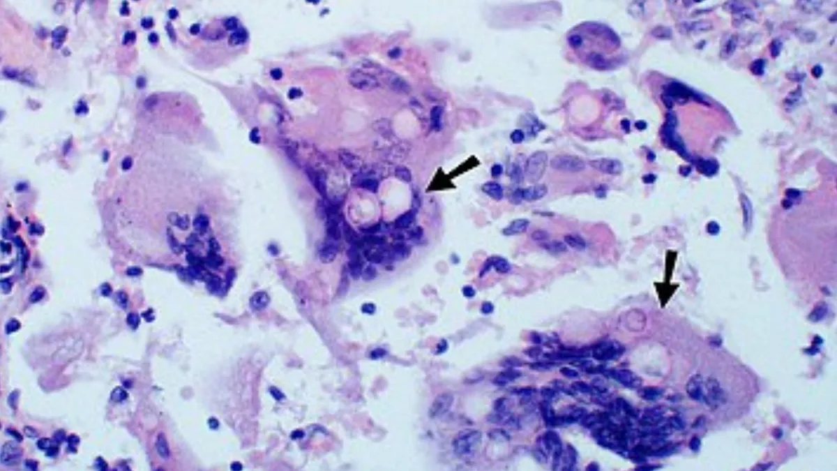 Budding yeasts in cytoplasm of giant cells at arrows. Broad-based budding and double contoured cell wall seen in the giant cell in the center is characteristic of Blastomyces dermatiditis.